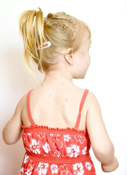 Baby girl with chicken pox rash — Stock Photo, Image