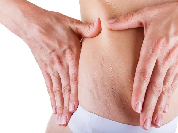 Stretch marks and cellulite — Stock Photo, Image