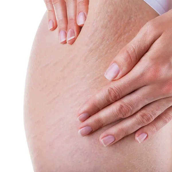 Stretch marks and cellulite — Stock Photo, Image