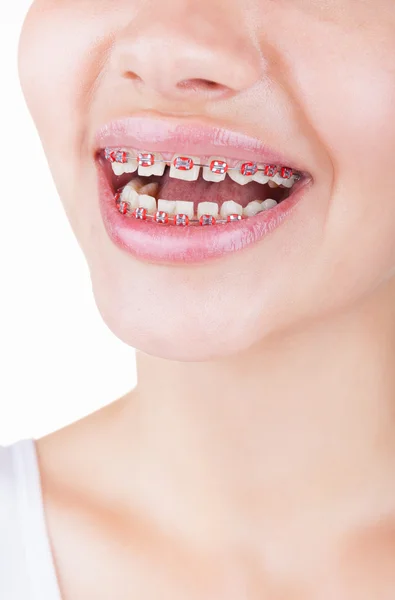 Teeth with braces — Stock Photo, Image