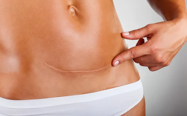 Woman showing scar — Stock Photo, Image