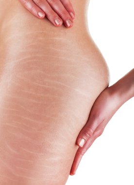 Stretch marks and cellulite  clipart