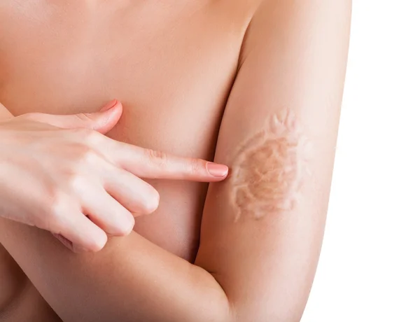 Woman showing scar — Stock Photo, Image