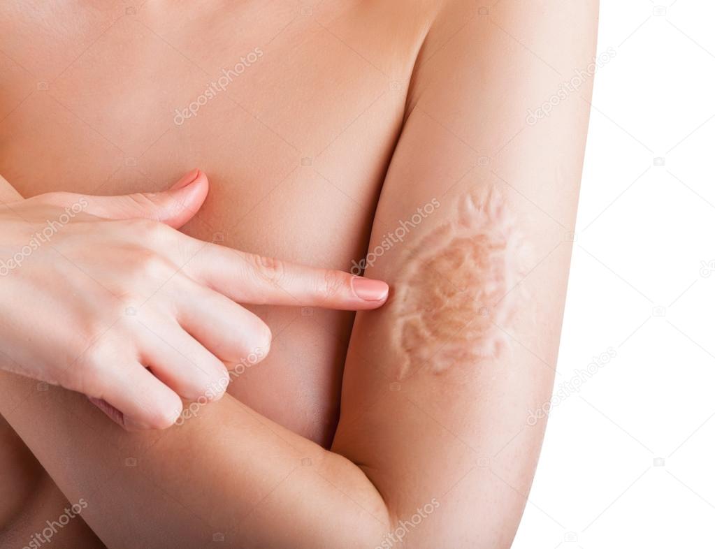 Woman showing scar