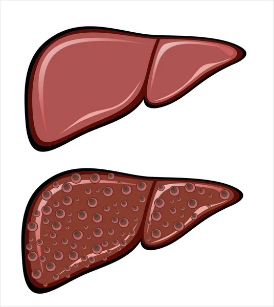 Enfermedad por cirrosis hepática — Archivo Imágenes Vectoriales