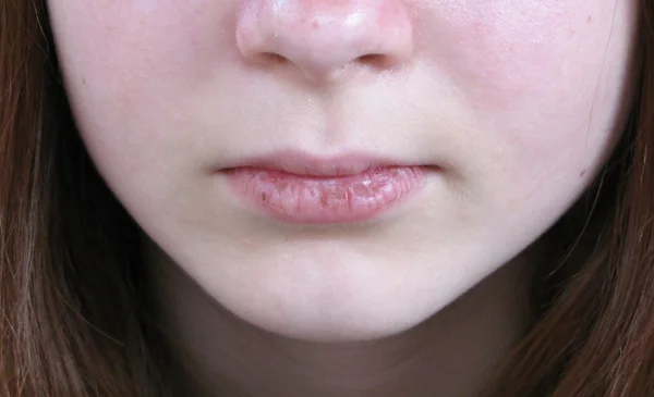 Lábios da doença — Fotografia de Stock