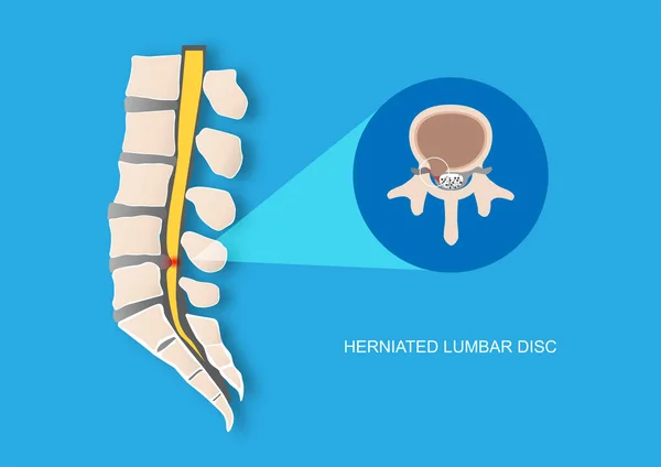 腰椎间盘突出引起的背痛的病媒图例 椎间盘突出导致神经根压 — 图库矢量图片