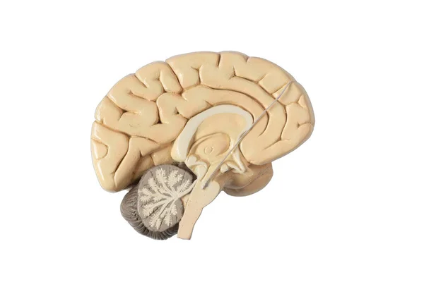 Stimolazione Cerebrale Profonda Nucleo Subtalamico Trattamento Del Morbo Parkinson Piombo — Foto Stock