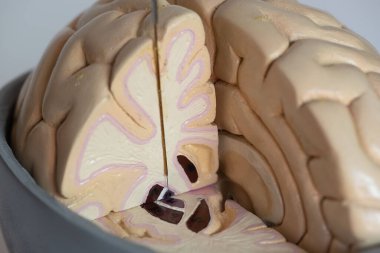 Parkinson hastalığı ameliyatı için globus pallidus 'un mikro elektrot kaydına yakından bakın.