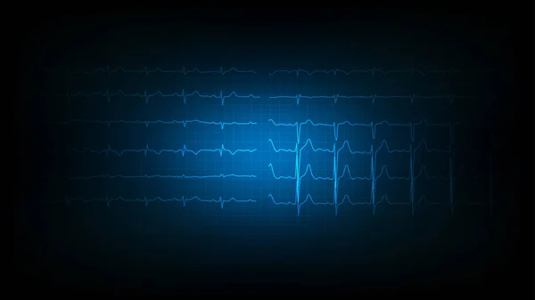 Illustratie Van Hartgolven Elektrocardiografie Display Monitoring — Stockvector