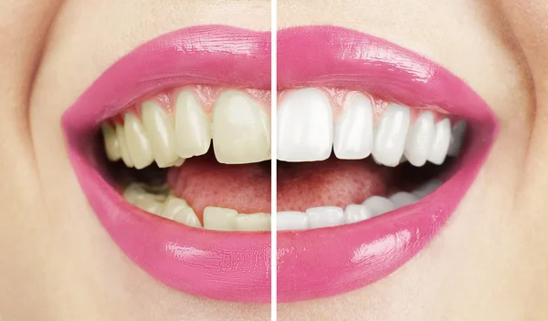 Blanqueamiento. Cuidado dental. mujer sana dientes blancos . —  Fotos de Stock