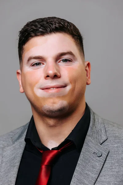 A young man with a non standard weight looking at camera is quite pleased with himself. Studio shot isolated white spots on the face. Vitiligo people accept themselves.