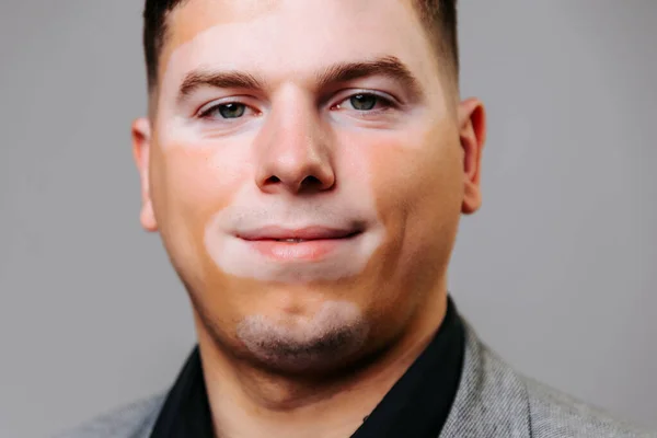 Studio gray background vitiligo young man gray eyes looking at camera is proud of himself. Self acceptance concept, skin pigmentation, a person with deviations standard, not a standard appearance.