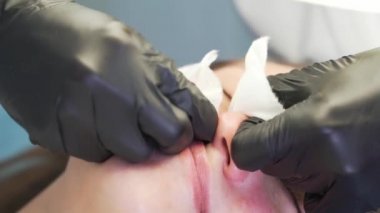 Doktor, kadının yüzündeki sivilceleri çıkartıyor. Siyah eldivenli eller steril süngerleri tutar ve açık tenli sivilceleri temizler. Lamba ve büyüteç, yüzü aydınlatır. Cilt temizleme işlemi