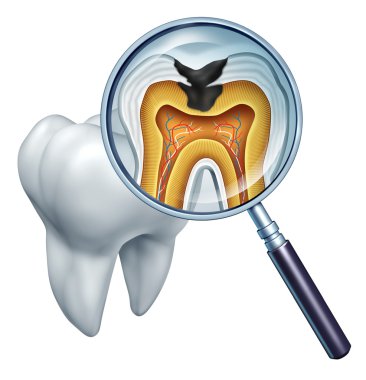 Tooth Cavity Close Up clipart