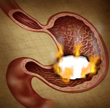 Stomach Ulcer clipart