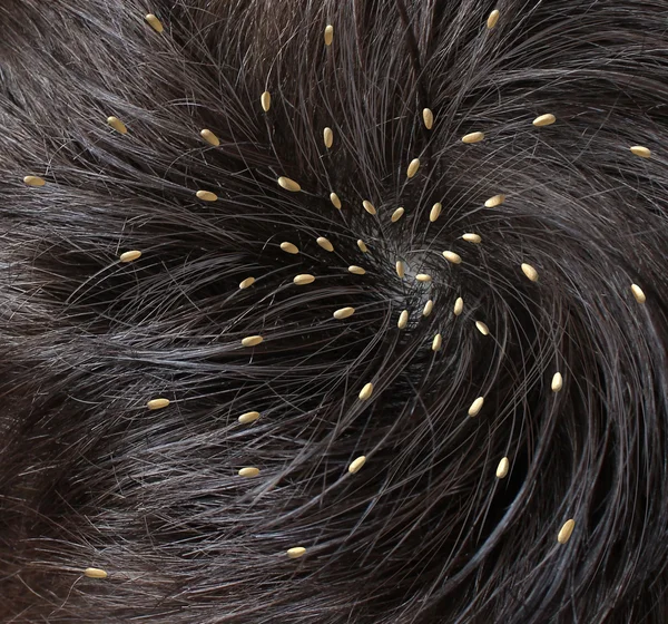 Head Lice — Stock Photo, Image