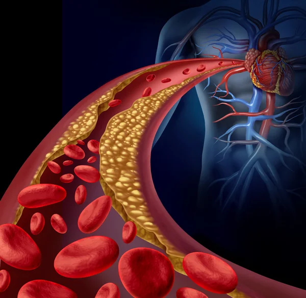 Verstopfte Arterie — Stockfoto