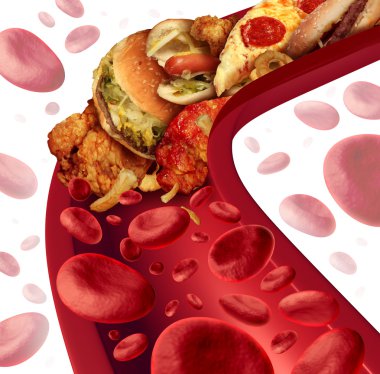 Cholesterol Blocked Artery clipart