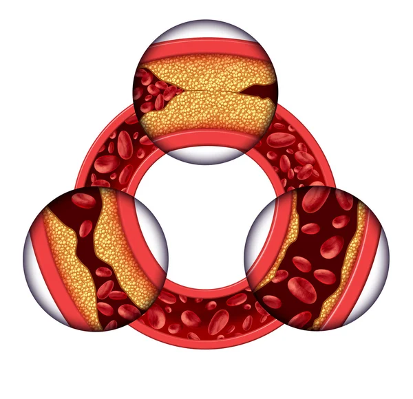 Болезнь коронарной артерии — стоковое фото