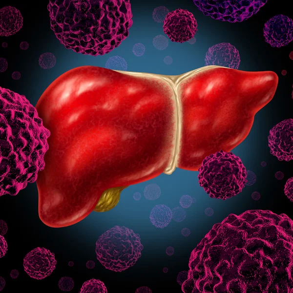 Mänskliga levercancer — Stockfoto