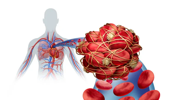 Pulmonale Mbolisme Ziekte Met Een Bloedstolsel Als Een Ziekte Met — Stockfoto