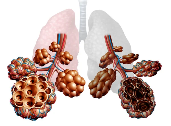 Emphysema Mint Légszomj Tüdőbetegség Mint Copd Betegség Krónikus Obstruktív Tüdőbetegség — Stock Fotó