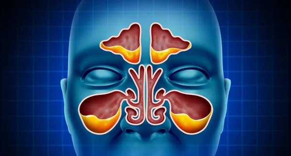Sinus Infection and Sinusitis illness as a nasal cavity blockage disease with a congested nose full of mucus or pus in a 3D illustration style.
