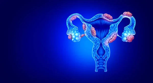 子宫内膜异位症女性不孕症的解剖概念 子宫和输卵管组织生长与三维图解 — 图库照片