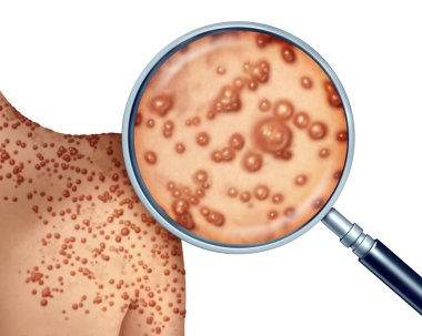 Monkeypox Virus Outbreak as a contagious infection as blisters and leisons on the skin representing transmission of an infected person with 3D illustration elements. clipart