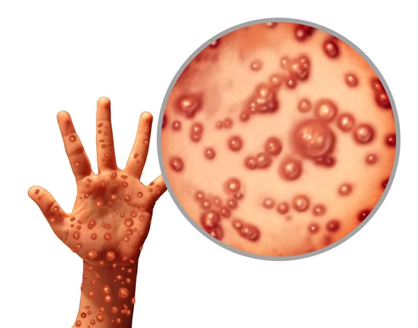 猴痘病毒感染爆发是一种传染性疾病 表现为皮肤上的水泡和病灶 以三维插图的形式表现感染者的传播 — 图库照片