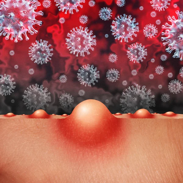 猴痘病毒爆发作为一种传染性感染 表现为皮肤上的水泡和病灶 带有三维插图元素 代表感染者的传播 — 图库照片