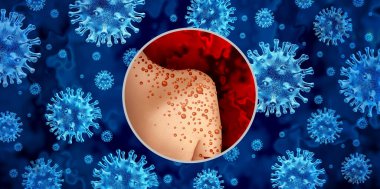 Monkey Pox or Monkeypox Virus Outbreak as a contagious infection as blisters and leisons on the skin representing transmission of an infected person with 3D illustration elements. clipart
