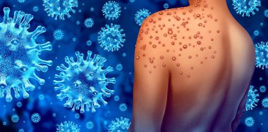 Monkeypox or Monkey Pox Virus Outbreak as a contagious infection as blisters and leisons on the skin representing transmission of an infected person with 3D illustration elements. clipart