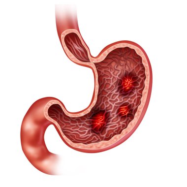Stomach Ulcers and a painful ulcer concept with burning indigestion pain in the digestive system as a medical illustration of the human digestion organ in a 3D illustration style. clipart