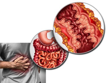 Crohn's disease pain and Crohn syndrome illness or crohns disorder as a medical concept with a close up of a human intestine with inflammation symptoms causing obstruction with 3D illustration elements. clipart