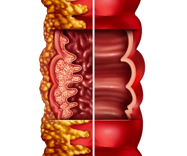 Crohn Disease Crohn Syndrome Illness Crohns Illness Healthy Colon Medical — Stok fotoğraf