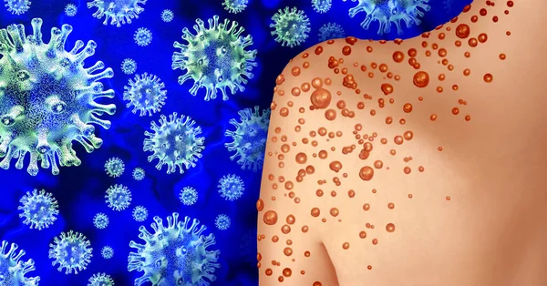 Monkey Pox Monkeypox Virus Outbreak Contagious Infection Blisters Leisons Skin — Stock Photo, Image