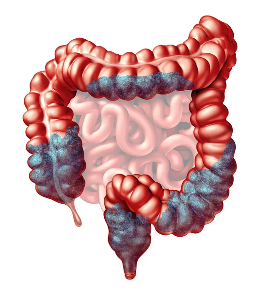 Anatomía Del Estreñimiento Síntomas Estreñidos Como Problema Evacuación Intestinal Como — Foto de Stock