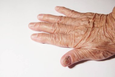 Mantar enfeksiyonu kapmış yaşlı bir kadının tırnağı..