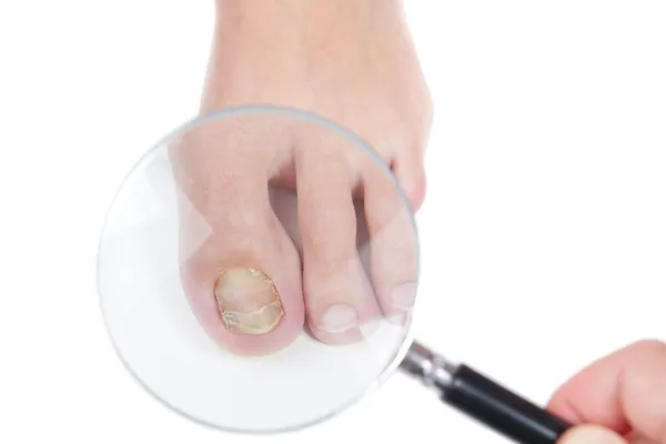 Doctor dermatologist examines the nail on the presence of the fu — Stock Photo, Image