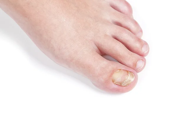 Skin fungus on the nail, on the female foot. Close-up. — Stock Photo, Image