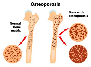 Osteoporosis clipart