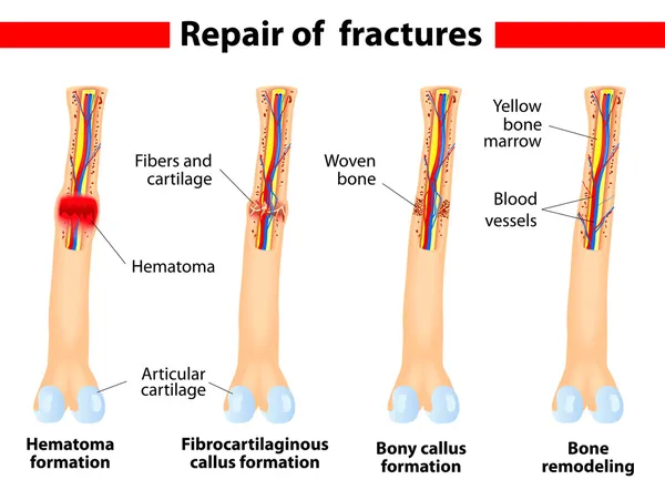 Proceso de curación de fracturas óseas — Vector de stock