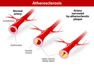 cvd hastalarda ateroskleroz verilmektedir.
