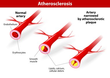 Illustrates the progression of atherosclerosis in CVD patients. clipart