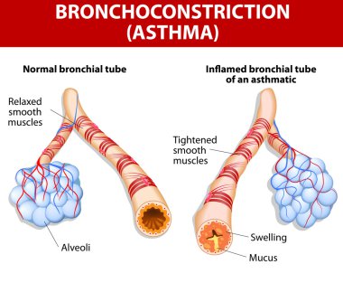 Inflamation of the bronchus causing asthma clipart