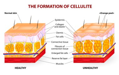 The formation of cellulite. Vector diagram clipart