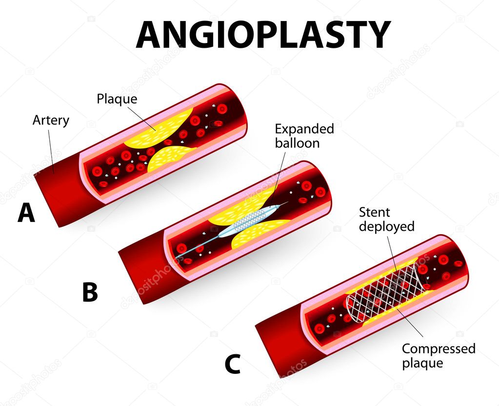 Coronary Balloon Angioplasty. Vector diagram