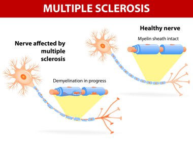 Nerve affected by multiple sclerosis clipart